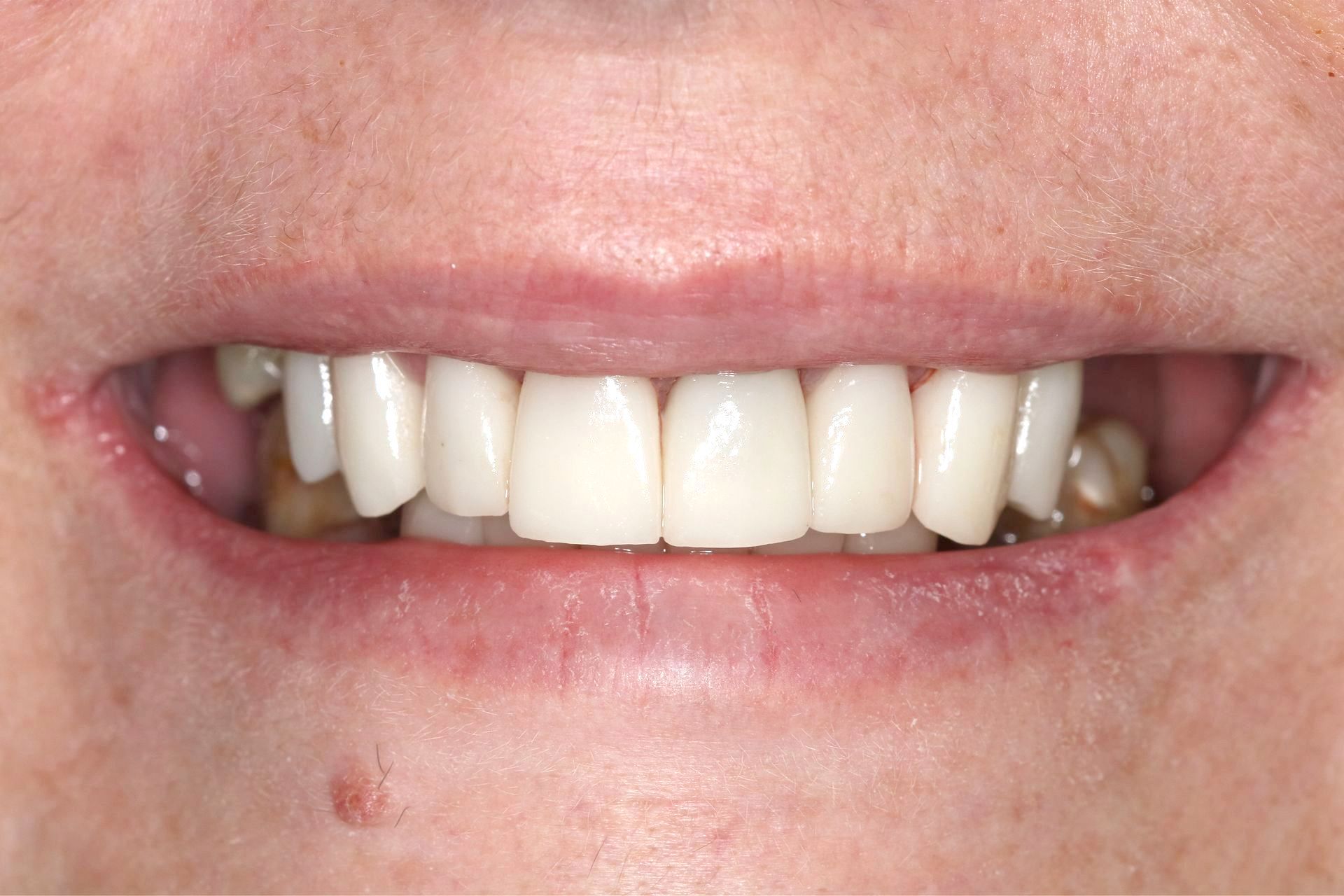 Patient 1 after treatment at Dr. Ramirez Aesthetic Dentistry
