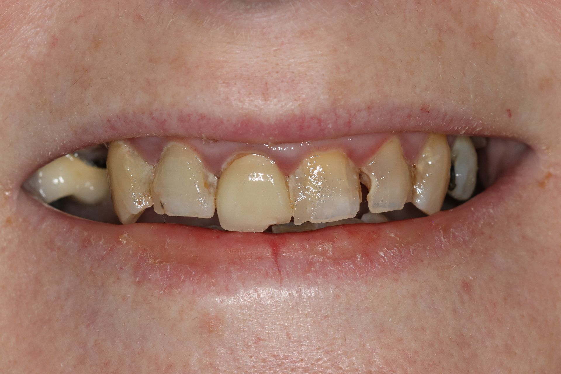Patient 1 before treatment at Dr. Ramirez Aesthetic Dentistry