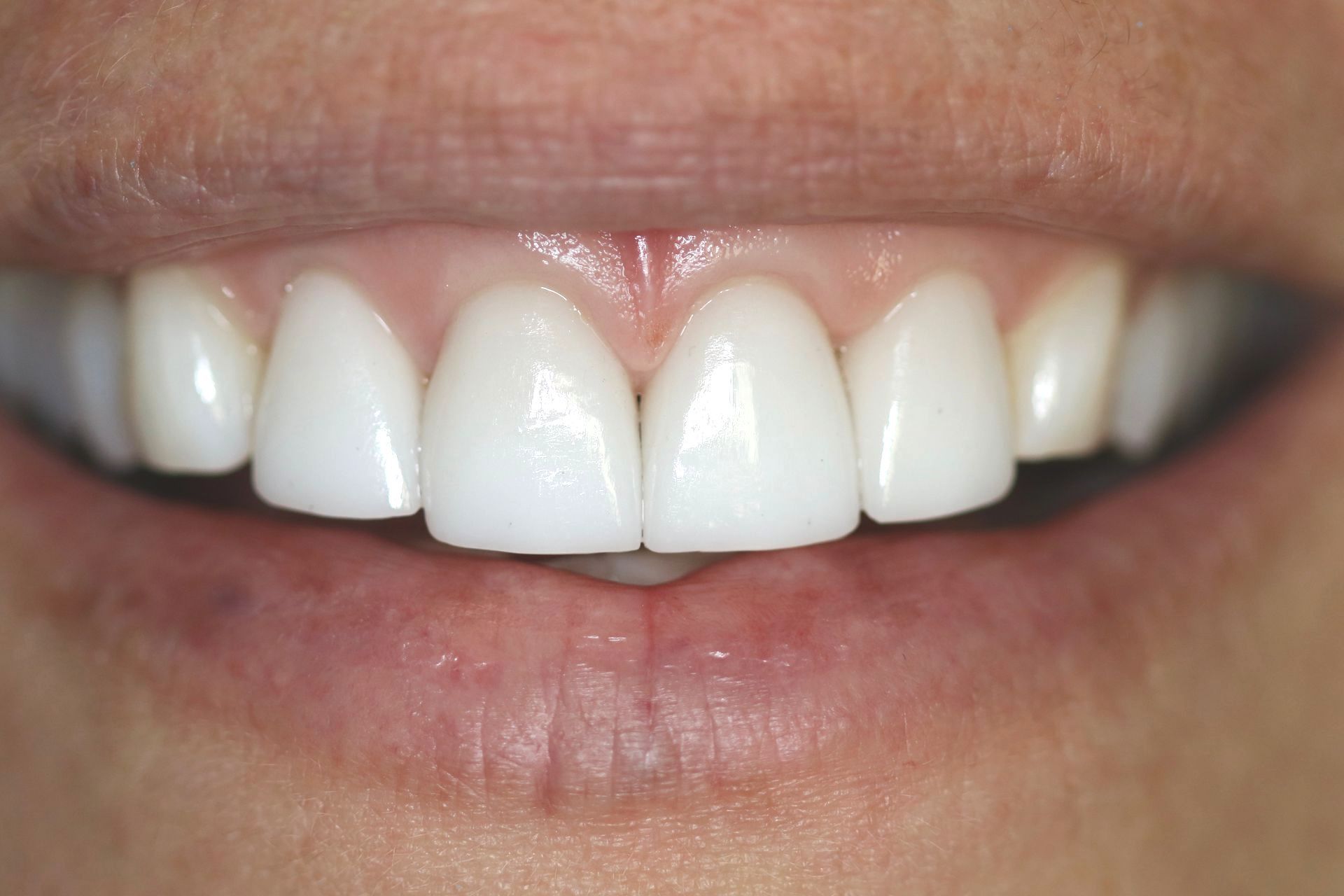Patient 2 after treatment at Dr. Ramirez Aesthetic Dentistry