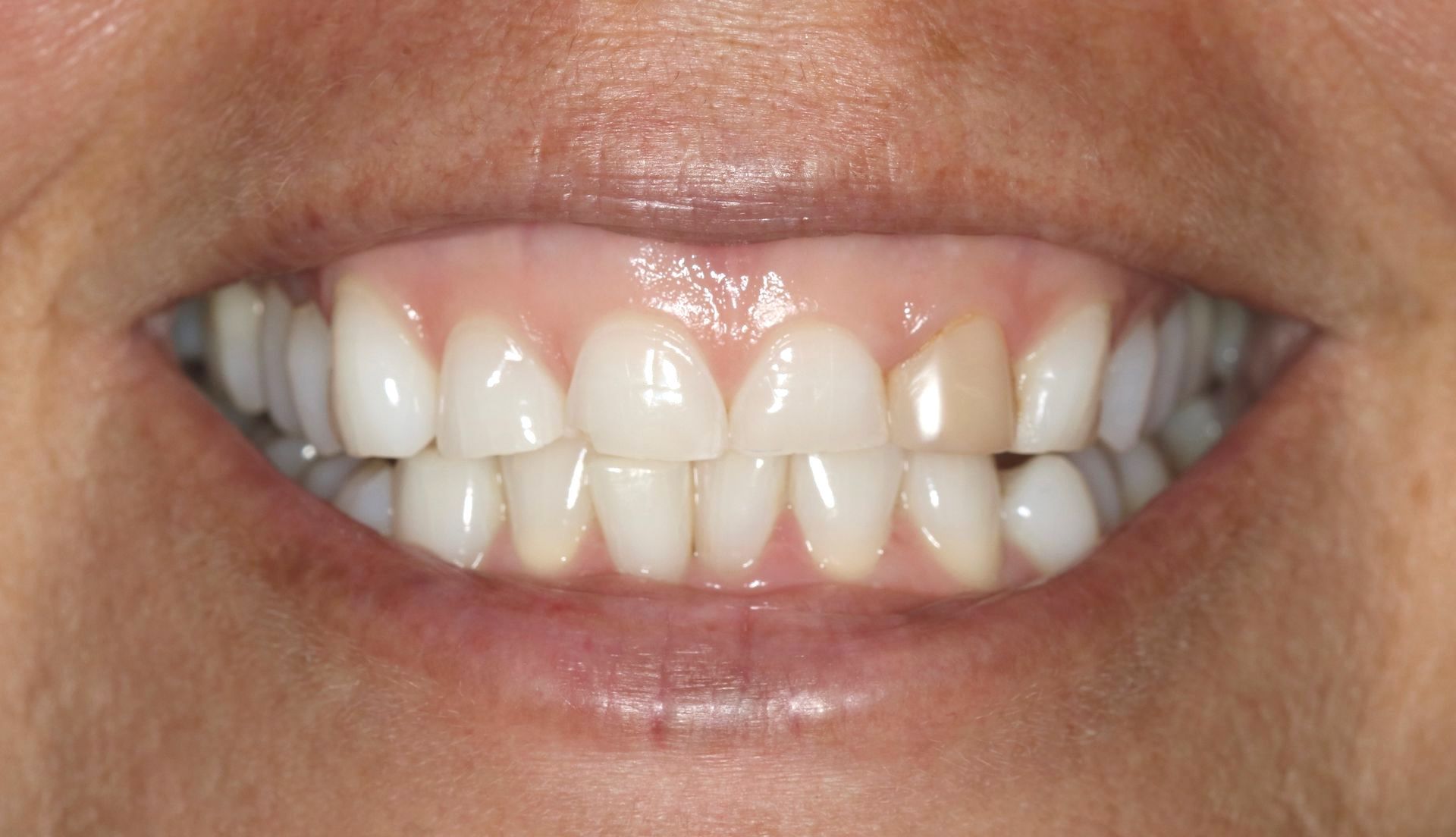 Patient 2 before treatment at Dr. Ramirez Aesthetic Dentistry