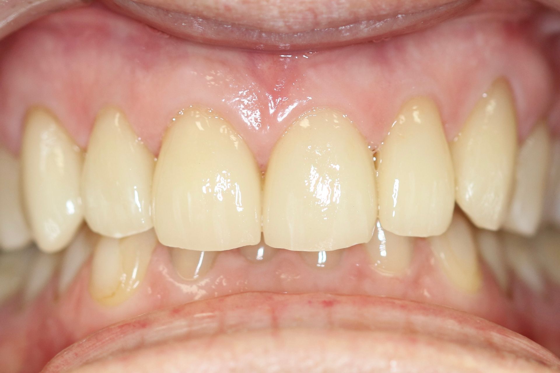 Patient 3 after treatment at Dr. Ramirez Aesthetic Dentistry