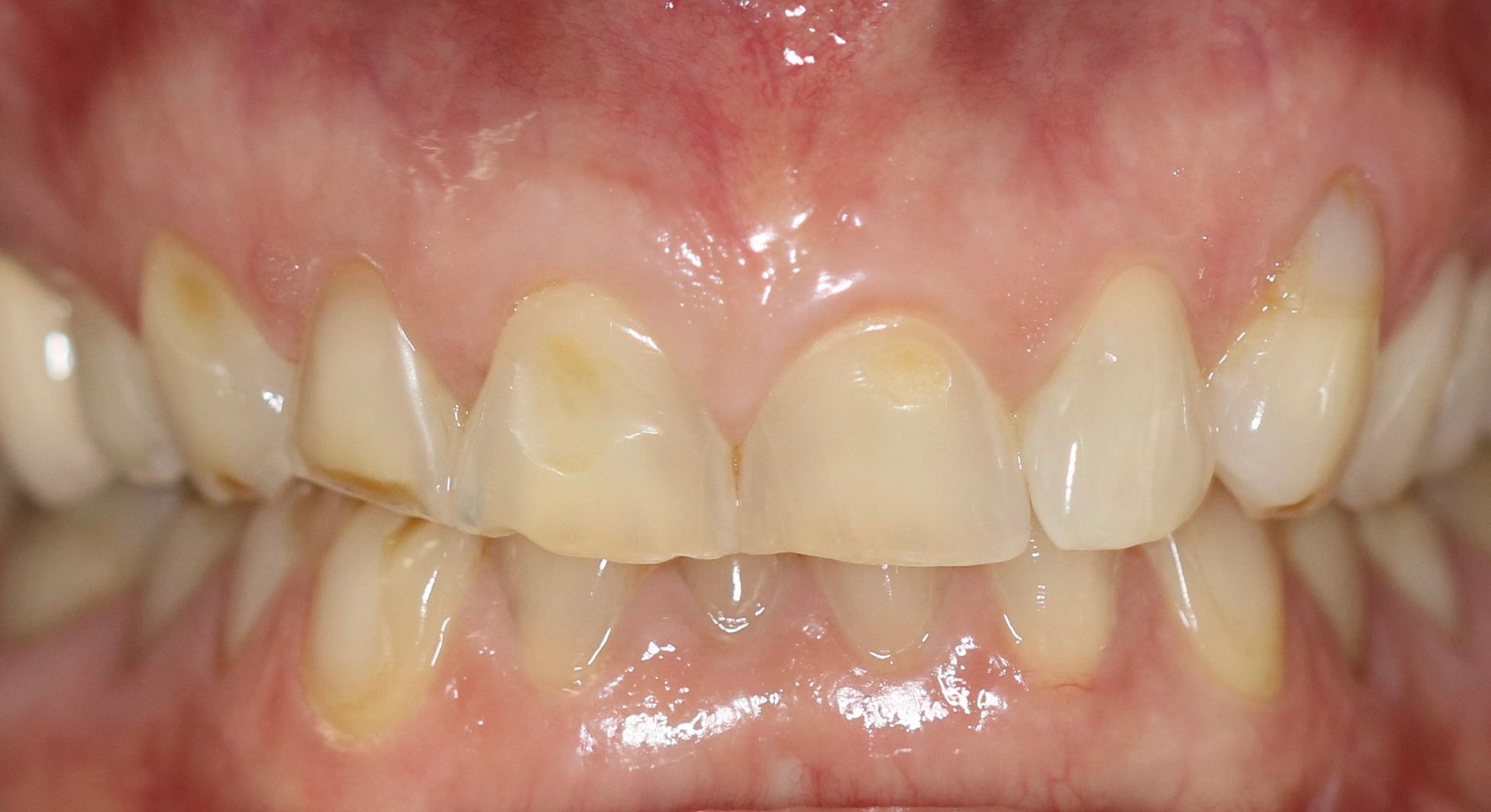 Patient 3 before treatment at Dr. Ramirez Aesthetic Dentistry