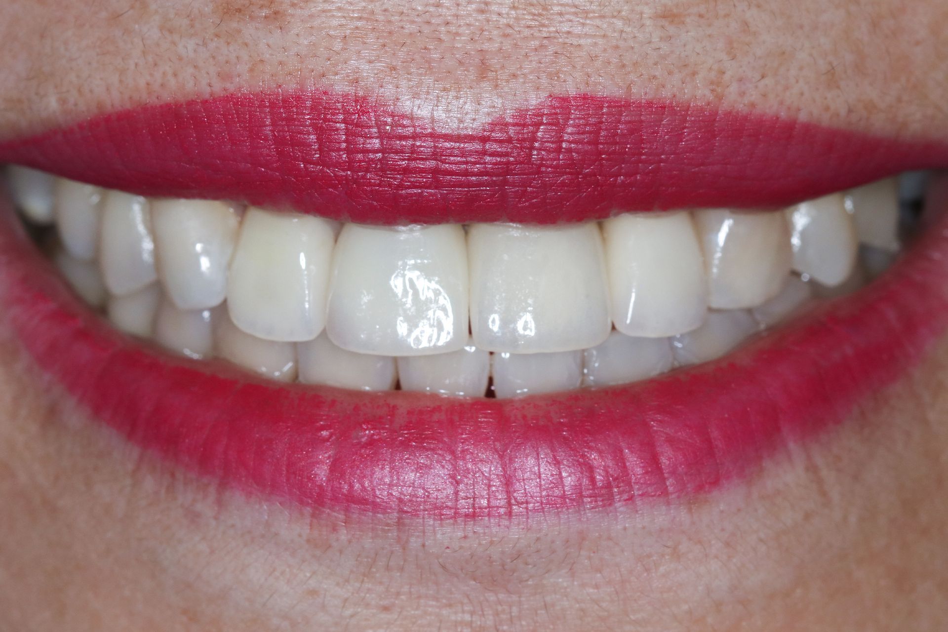 Patient 4 after treatment at Dr. Ramirez Aesthetic Dentistry