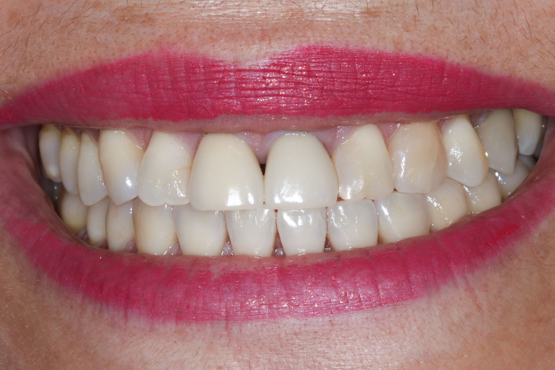 Patient 4 before treatment at Dr. Ramirez Aesthetic Dentistry