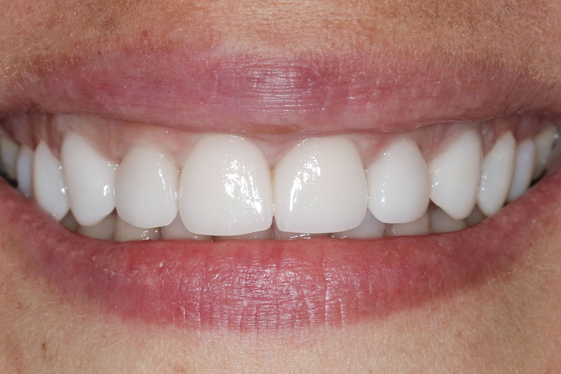 Patient 5 after treatment at Dr. Ramirez Aesthetic Dentistry