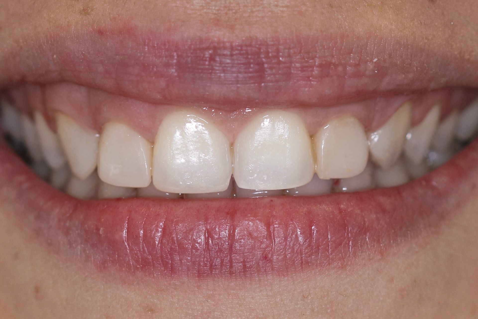 Patient 5 before treatment at Dr. Ramirez Aesthetic Dentistry
