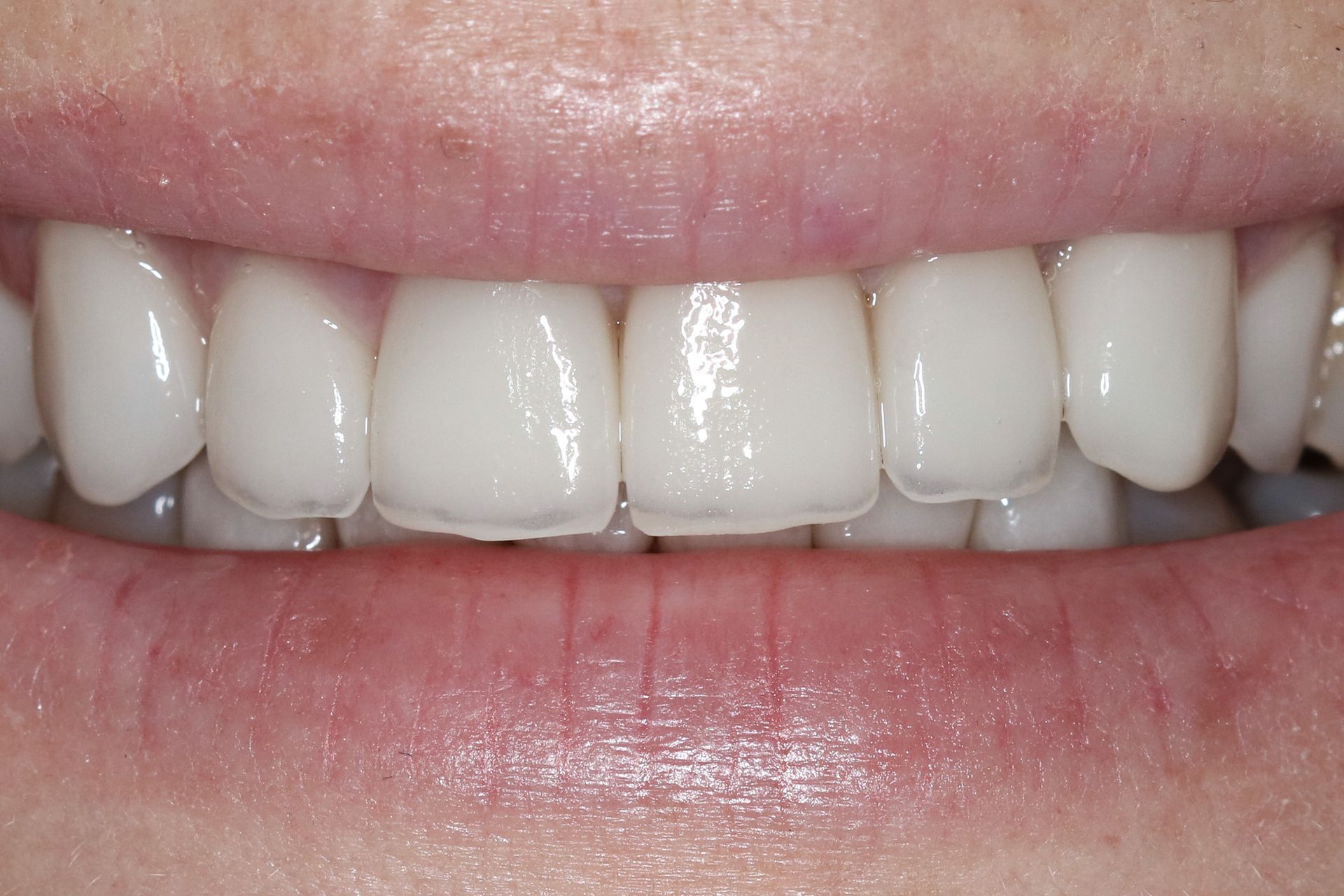 Patient 6 after treatment at Dr. Ramirez Aesthetic Dentistry
