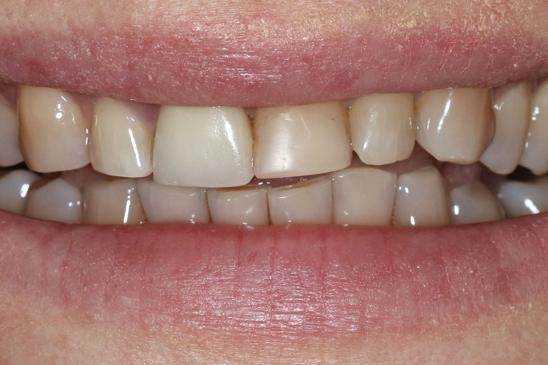 Patient 6 before treatment at Dr. Ramirez Aesthetic Dentistry
